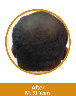 After Baldness Treatment In India